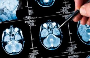 Científicos hallaron una proteína que logra eliminar las células cancerosas del cerebro