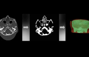 Inteligencia artificial para cirugías más seguras en la cabeza