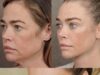 Denise Richards y su lifting facial: una experiencia que reabre el debate sobre la cirugía estética