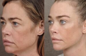 Denise Richards y su lifting facial: una experiencia que reabre el debate sobre la cirugía estética