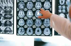 Investigadores españoles crean un parche de seda para reparar el cerebro después de un ictus