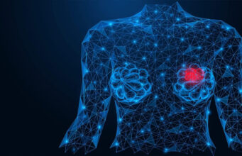 Impulsa la Inteligencia Artificial la detección temprana del cáncer de mama en México