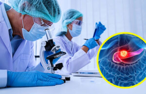 Científicos descubren células clave que podrían revolucionar la detección del cáncer de páncreas