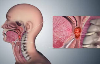 Virus del Papiloma Humano dispara casos de cáncer de orofaringe en población joven de México
